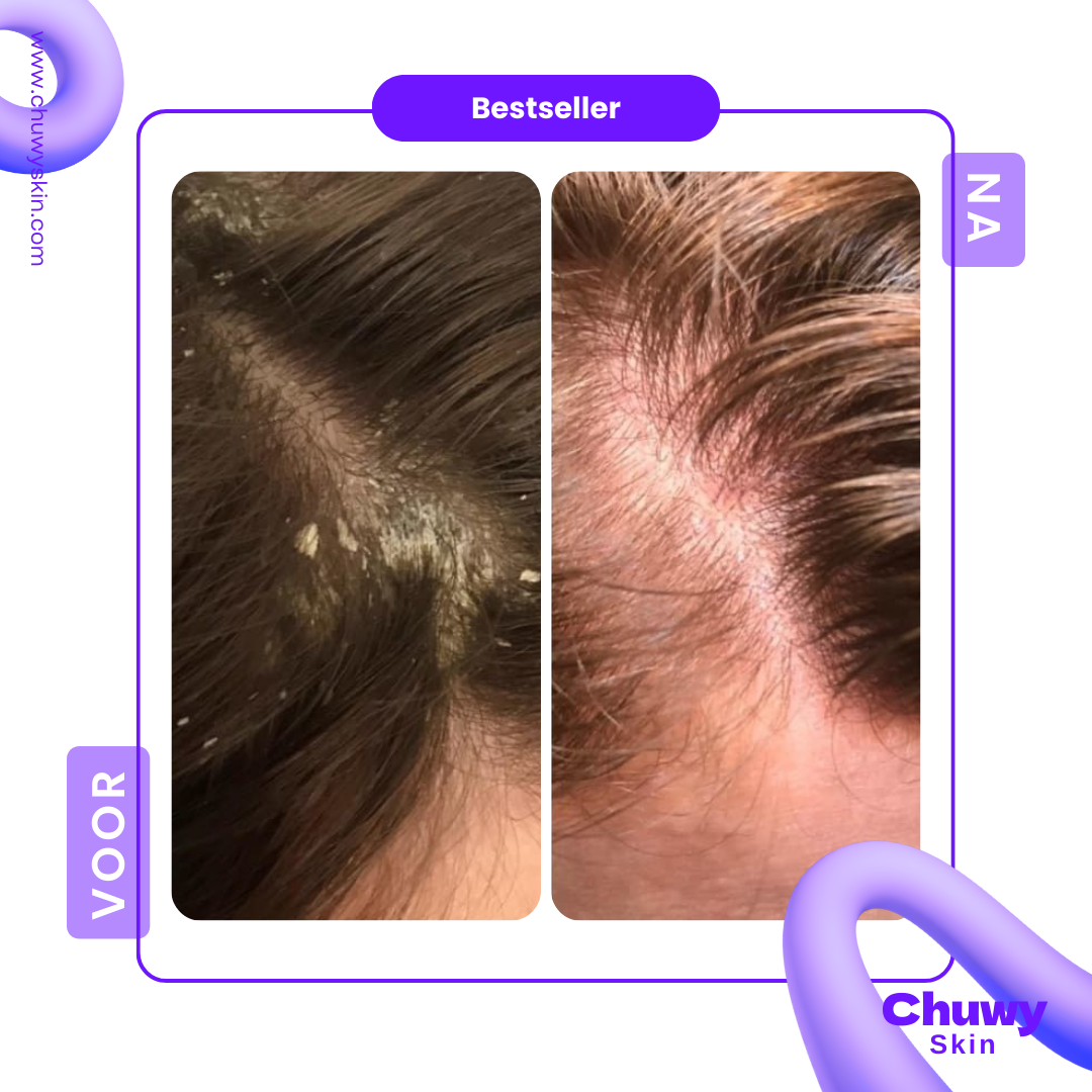 Scalp Comb