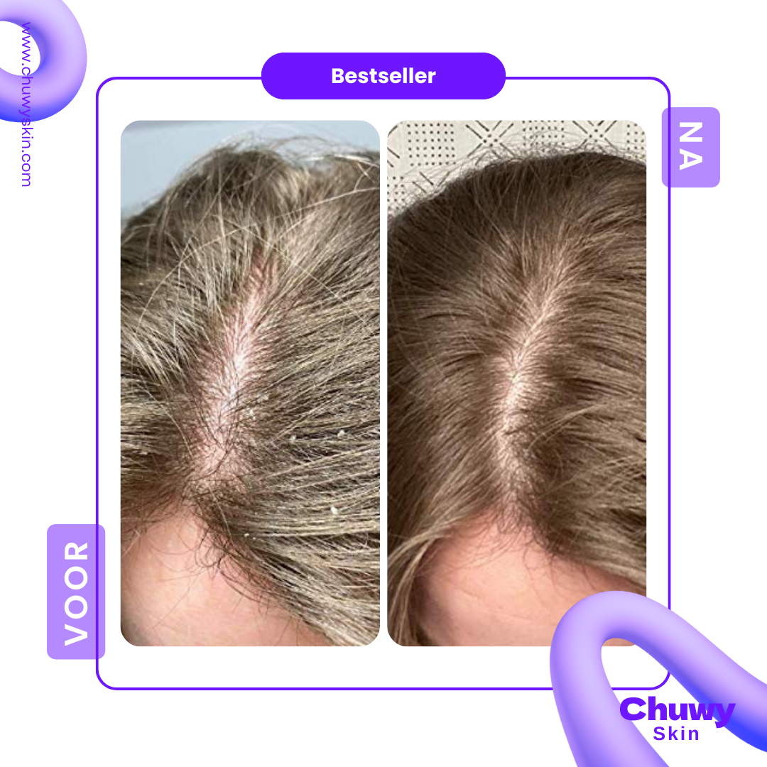 Scalp Comb