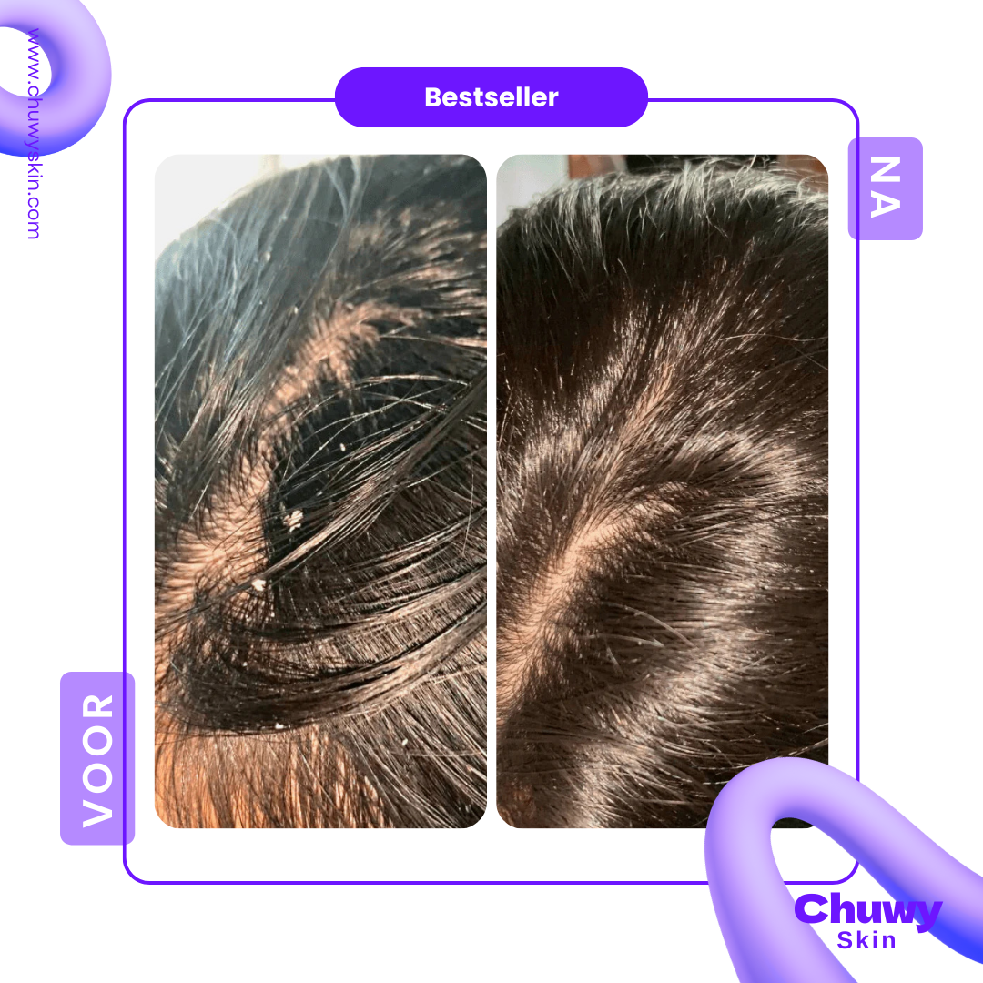 Scalp Comb